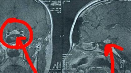 Boy With Gigantism Staying Positive With Surgery Looming