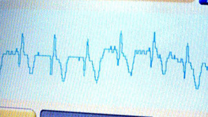 Why Younger Women Are More Likely To Die Of Heart Attacks